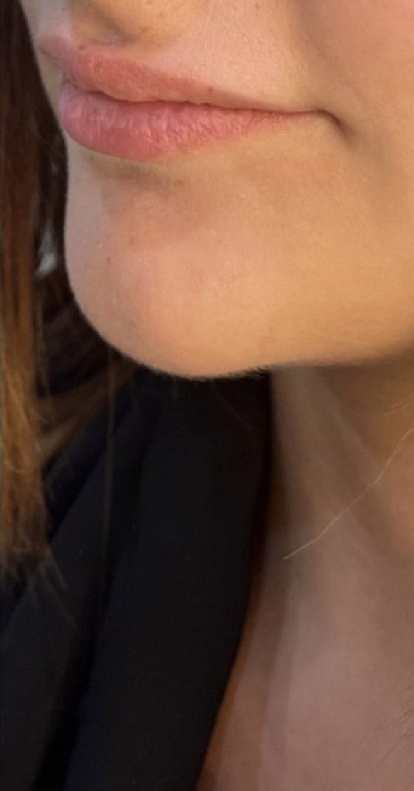 Lip Filler & Chin Enhancement — Before