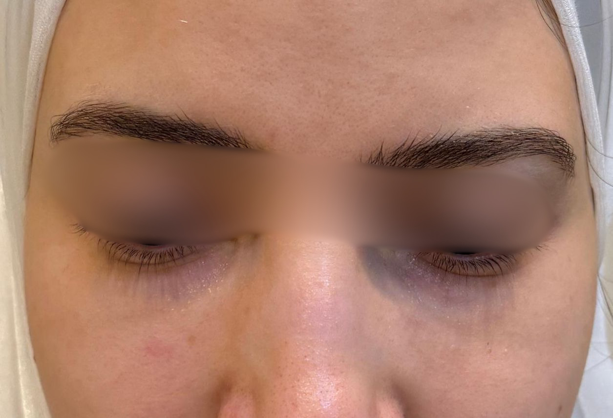 Filler Tear-Trough Treatment — after