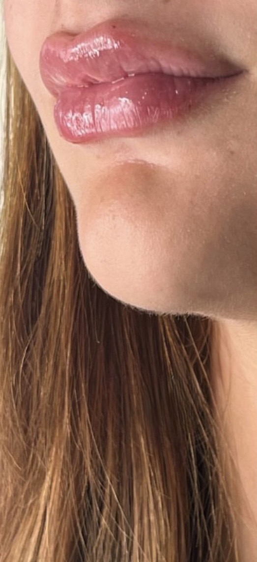 Lip Filler & Chin Enhancement — After