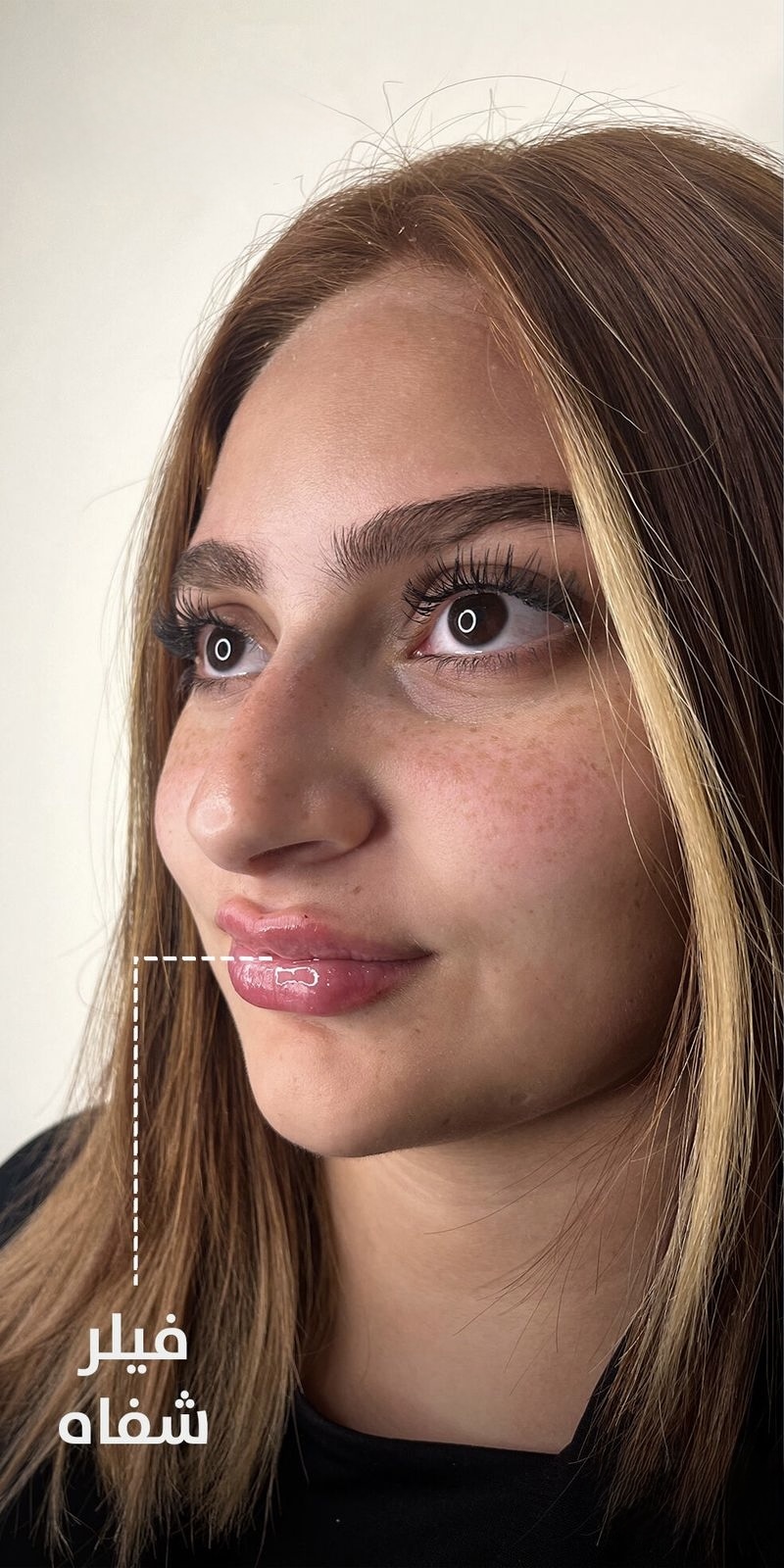 Lip Filler — Shape & Projection — After