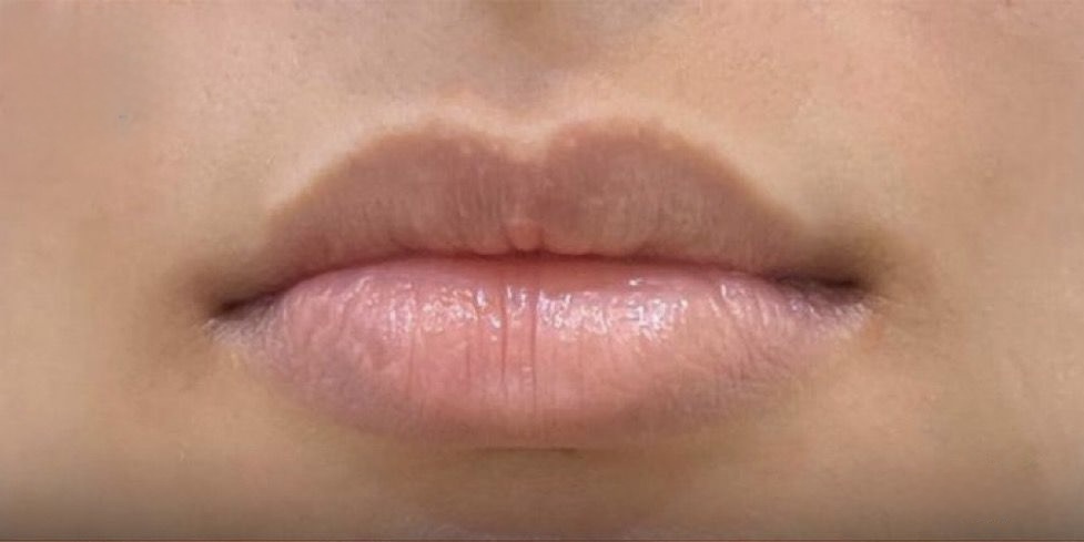 Lip Filler — Definition & Volume — Before