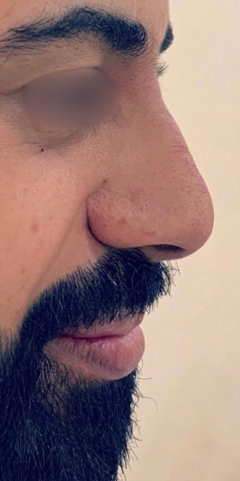 Nose Thread Lift — After
