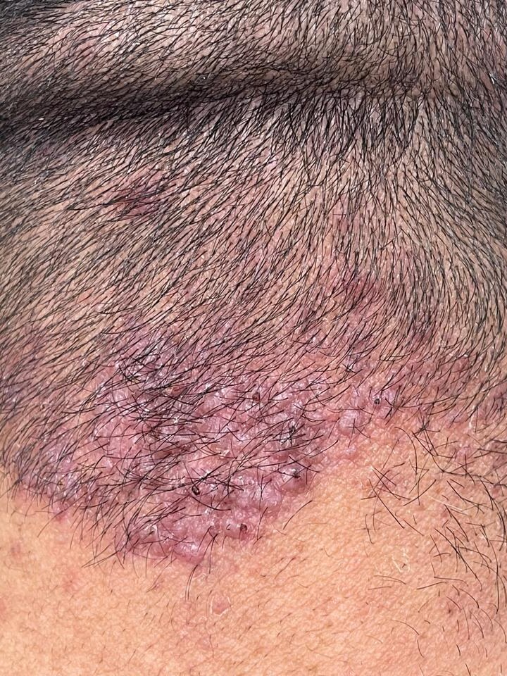 Acne Keloidalis Nuchae — Long-Pulsed Nd:YAG Laser — Before