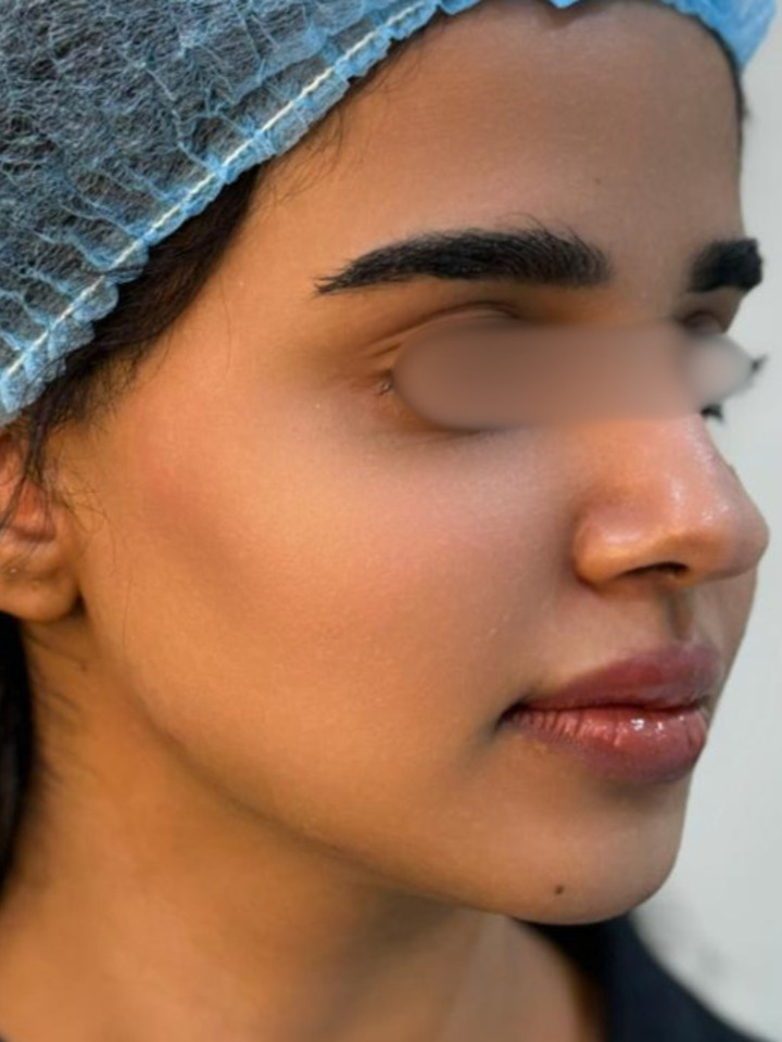 Jawline Contouring (Texas Technique) — After