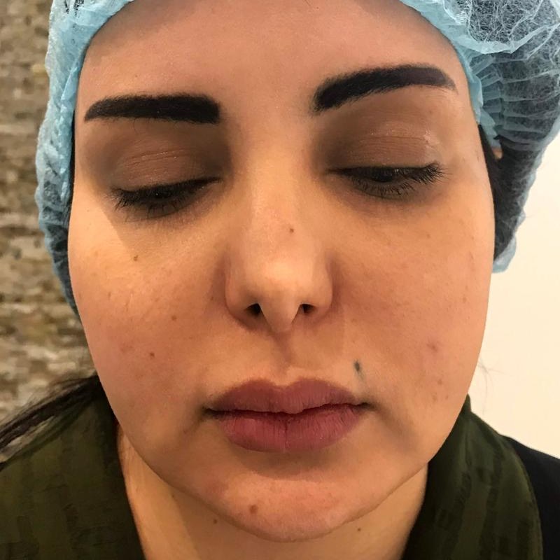 Thread Lifting — Face — before