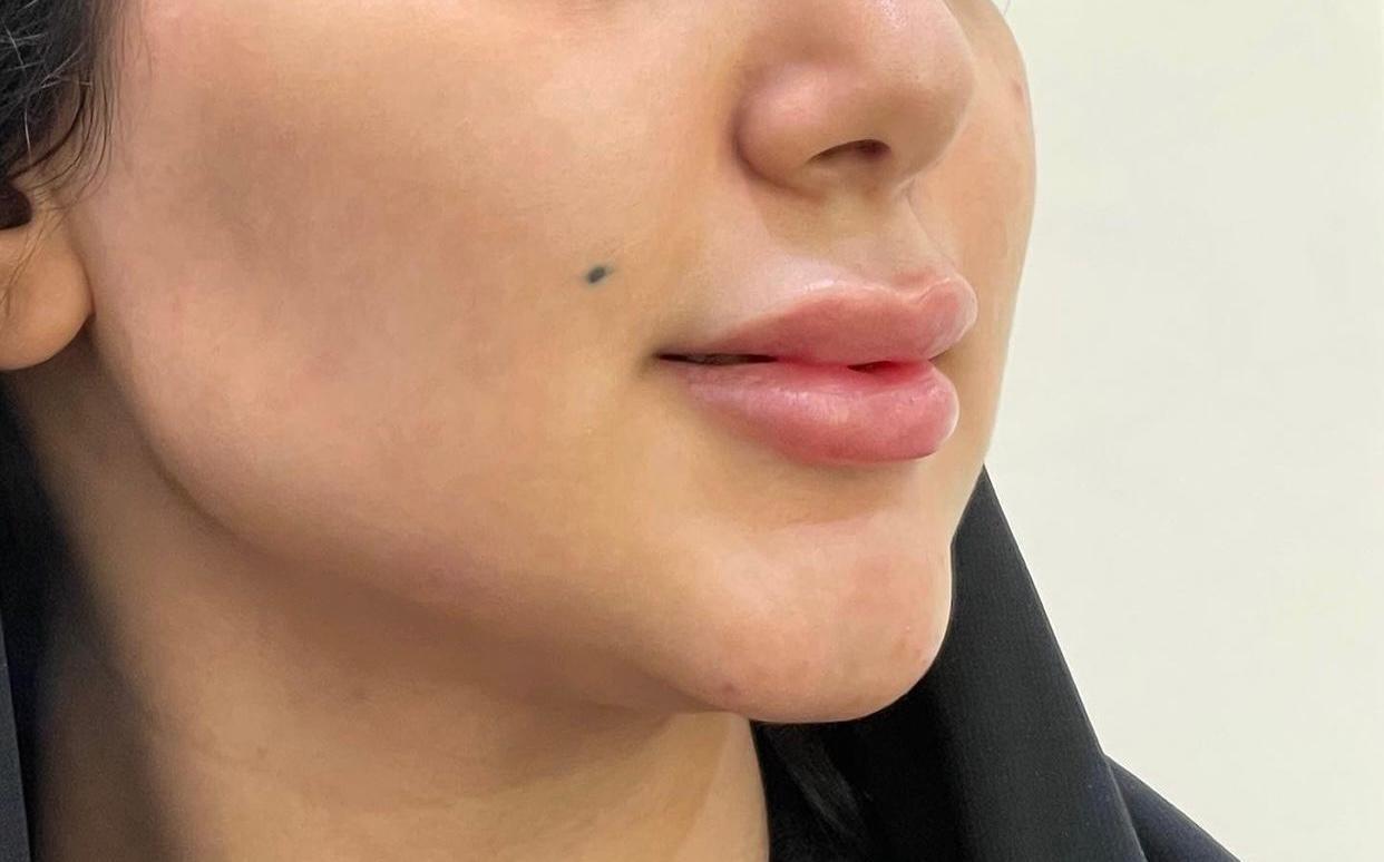 Texas Technique, Cheek Lift & Lip Filler — After