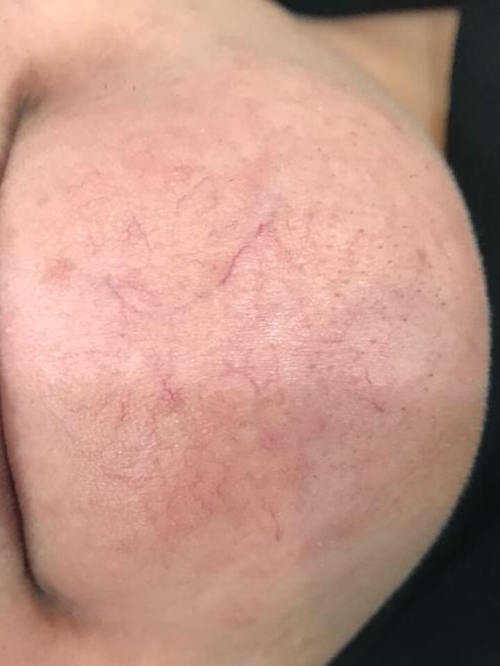 Chin Telangiectasia — Nd:YAG Laser — Before