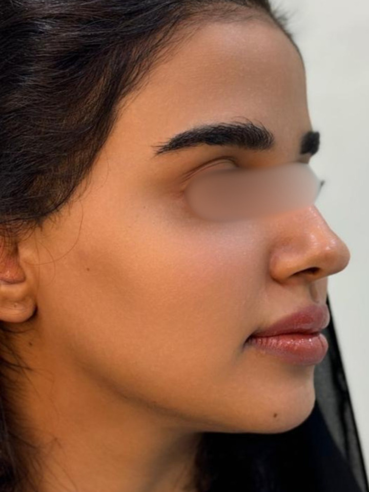 Jawline Contouring (Texas Technique) — Before