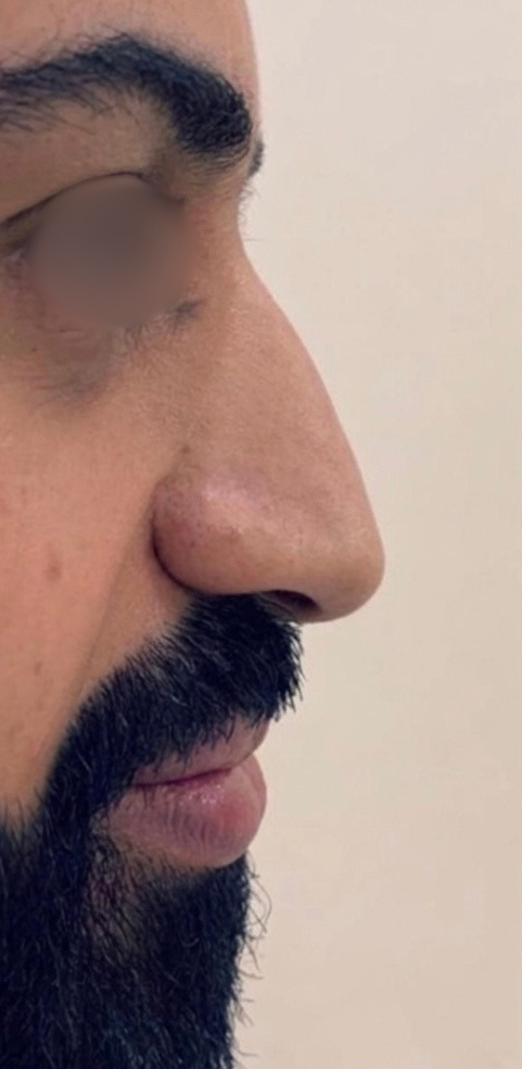 Nose Thread Lift — Before
