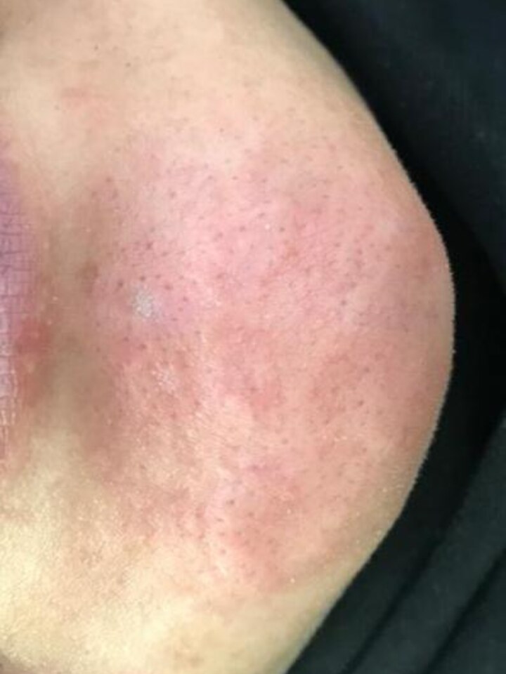 Chin Telangiectasia — Nd:YAG Laser — After