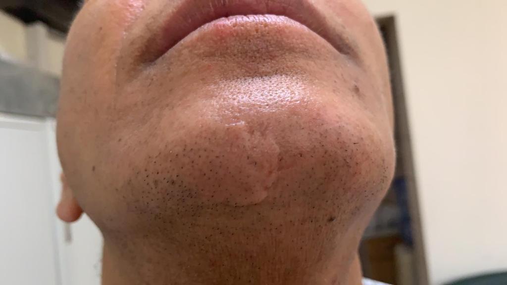 Chin Scar Revision — before