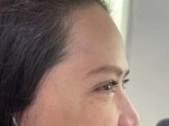 BOTOX — Forehead & Crow's Feet — After