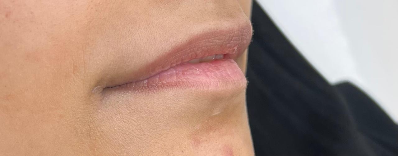 Lip Filler — Volume & Lifting — Before