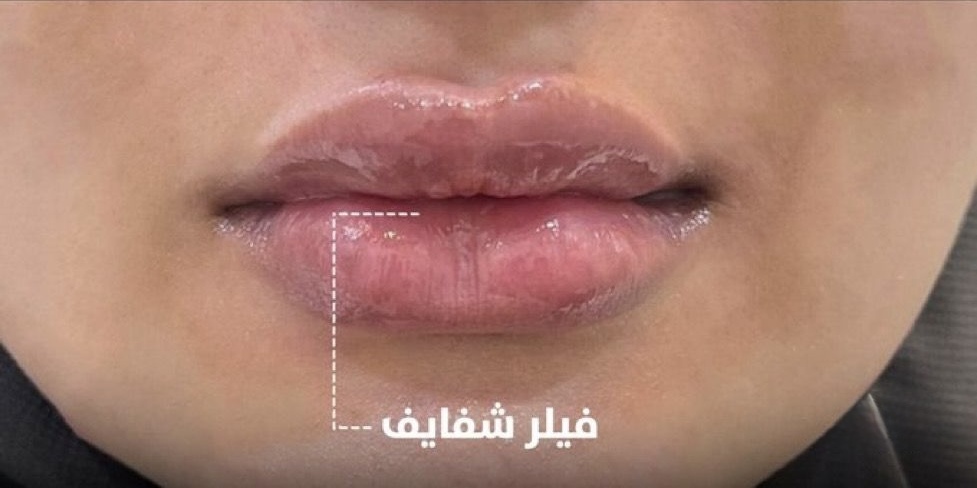 Lip Filler — Definition & Volume — After