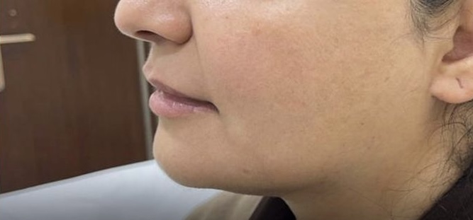 Jawline Contouring (Texas Technique) — Before