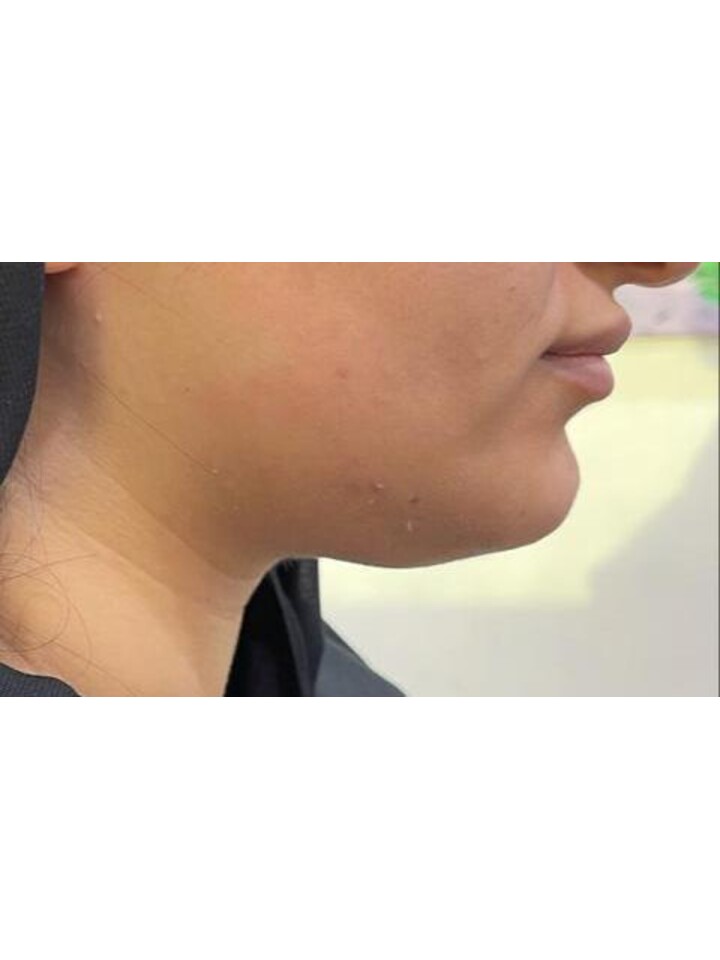 Neck Lift with Threads — Before