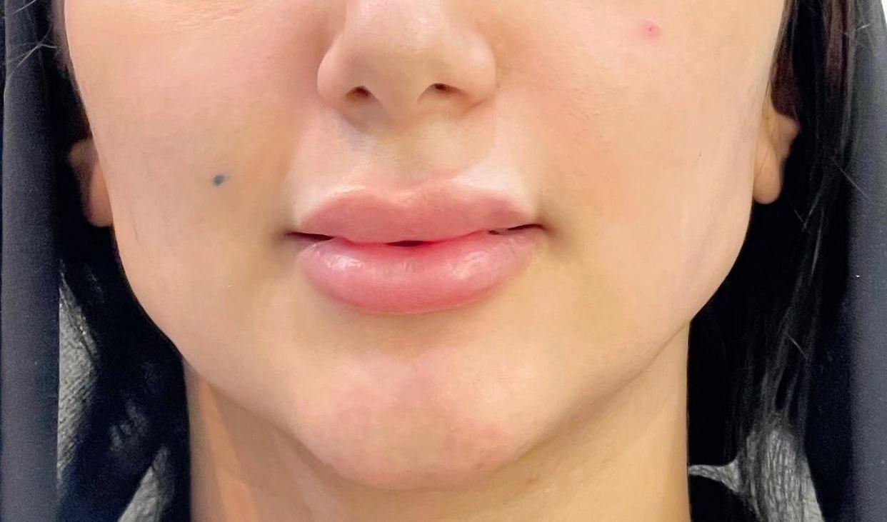 Texas Technique, Cheek Lift & Lip Filler — After