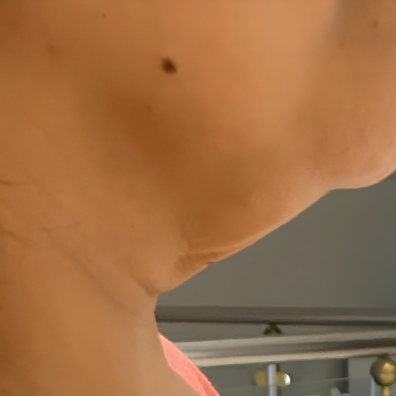Neck Lift & Double Chin Correction (SCULPTRA) — before