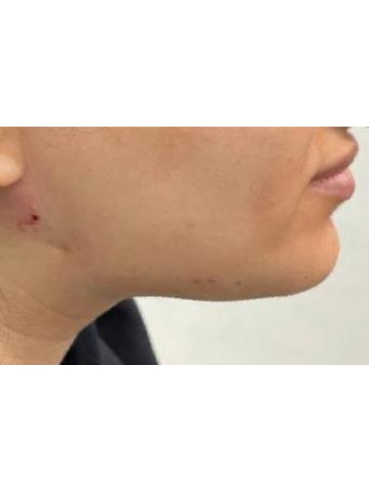 Neck Lift with Threads — After