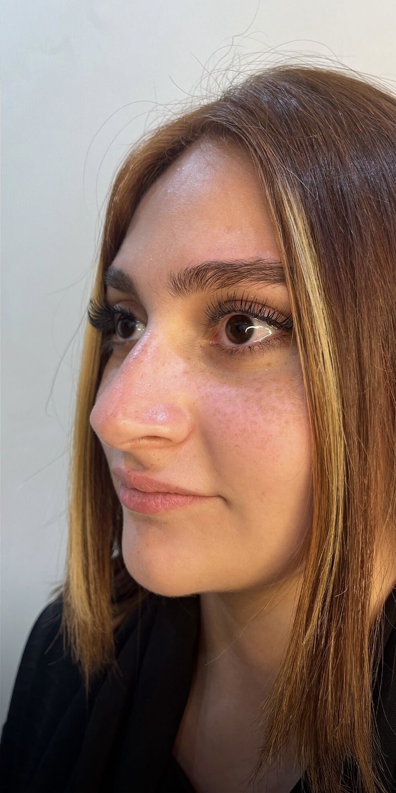 Lip Filler — Shape & Projection — Before