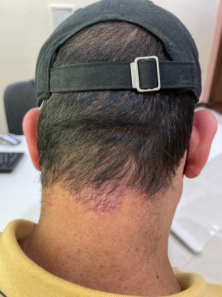 Acne Keloidalis Nuchae — Long-Pulsed Nd:YAG Laser — After