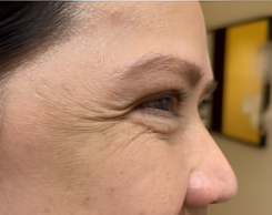 BOTOX — Forehead & Crow's Feet — Before