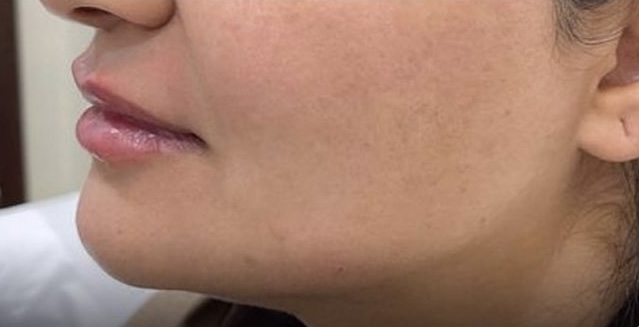 Jawline Contouring (Texas Technique) — After