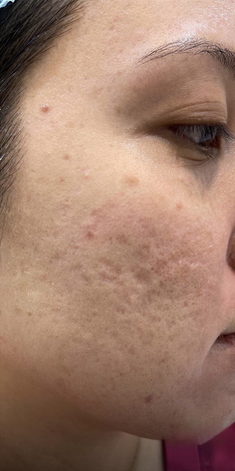 RF with Growth Factors — Before