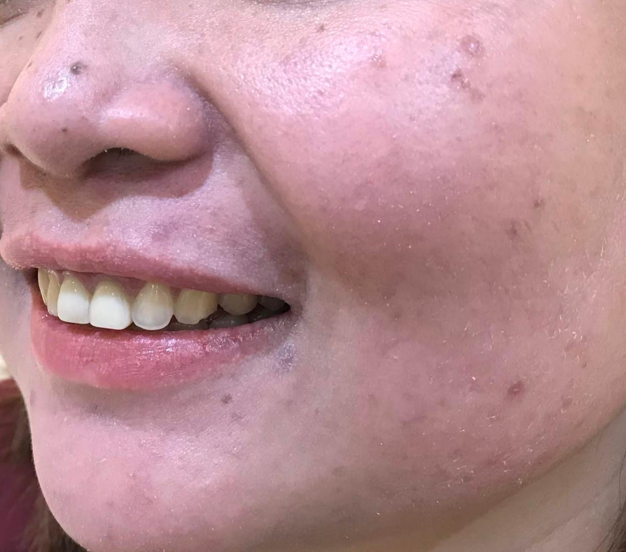 Active Acne & Redness — after
