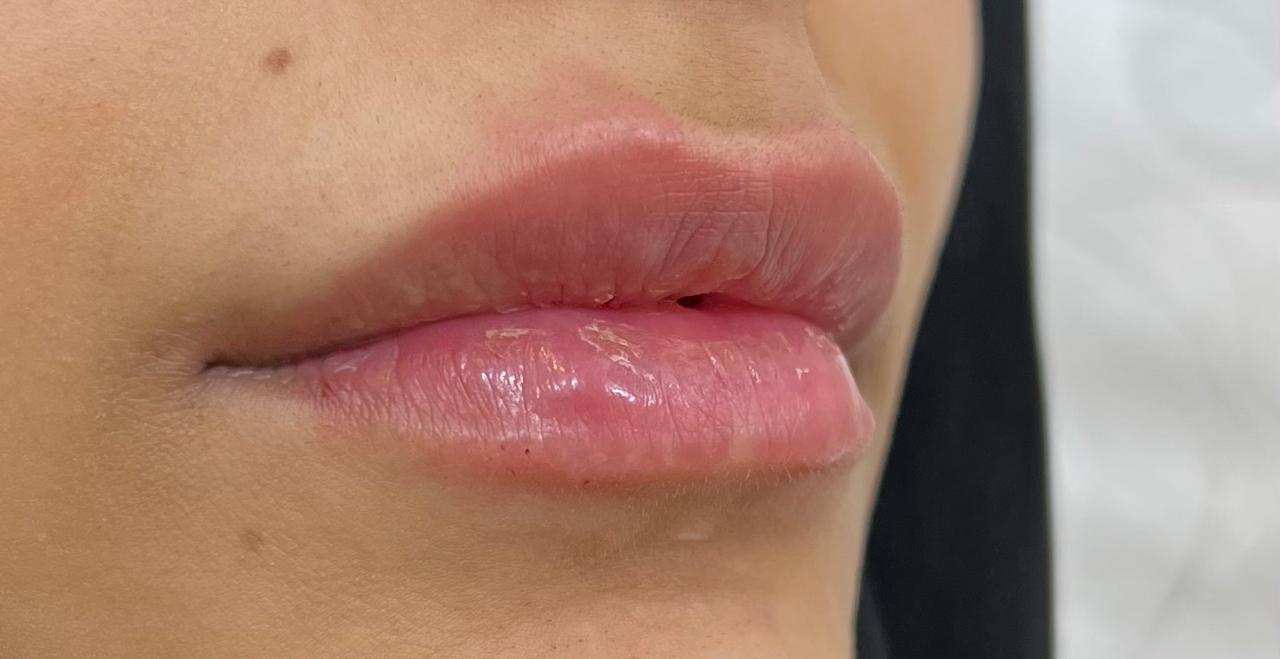 Lip Filler — Volume & Lifting — After