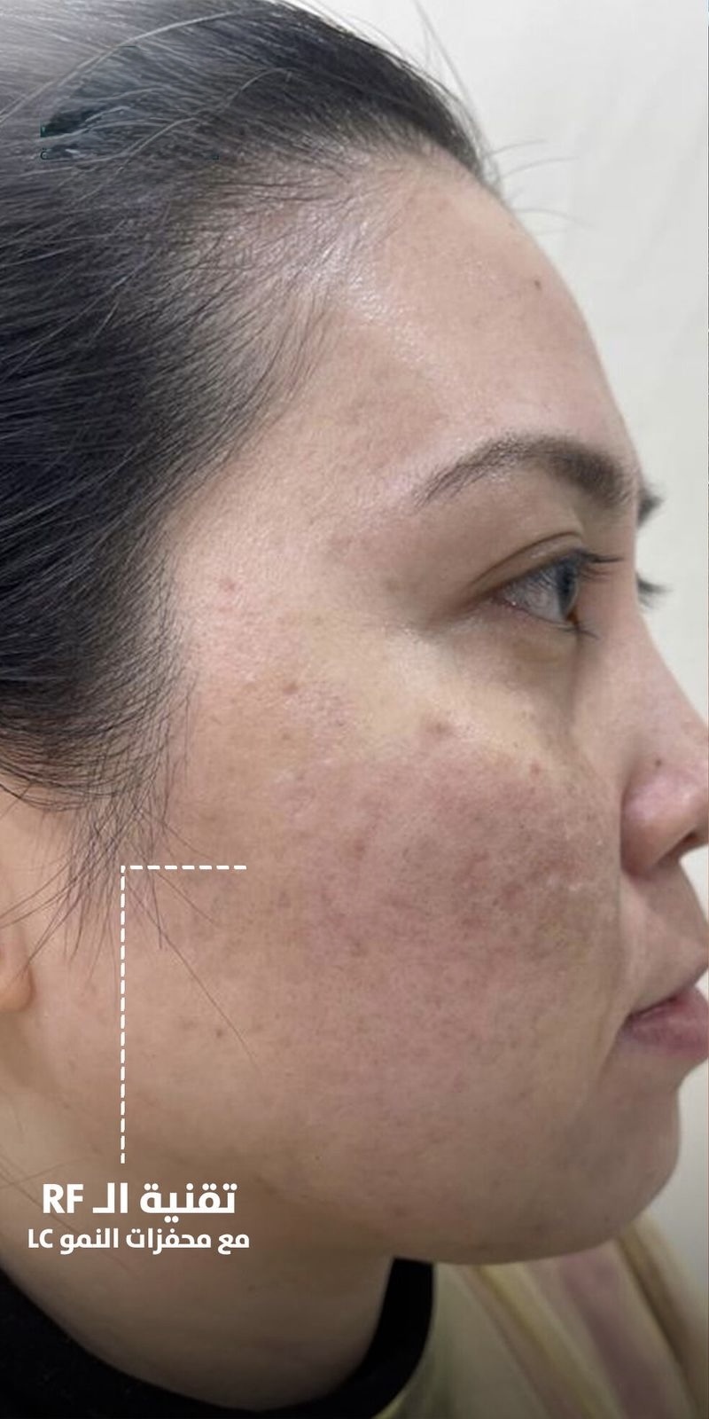 RF with Growth Factors — After